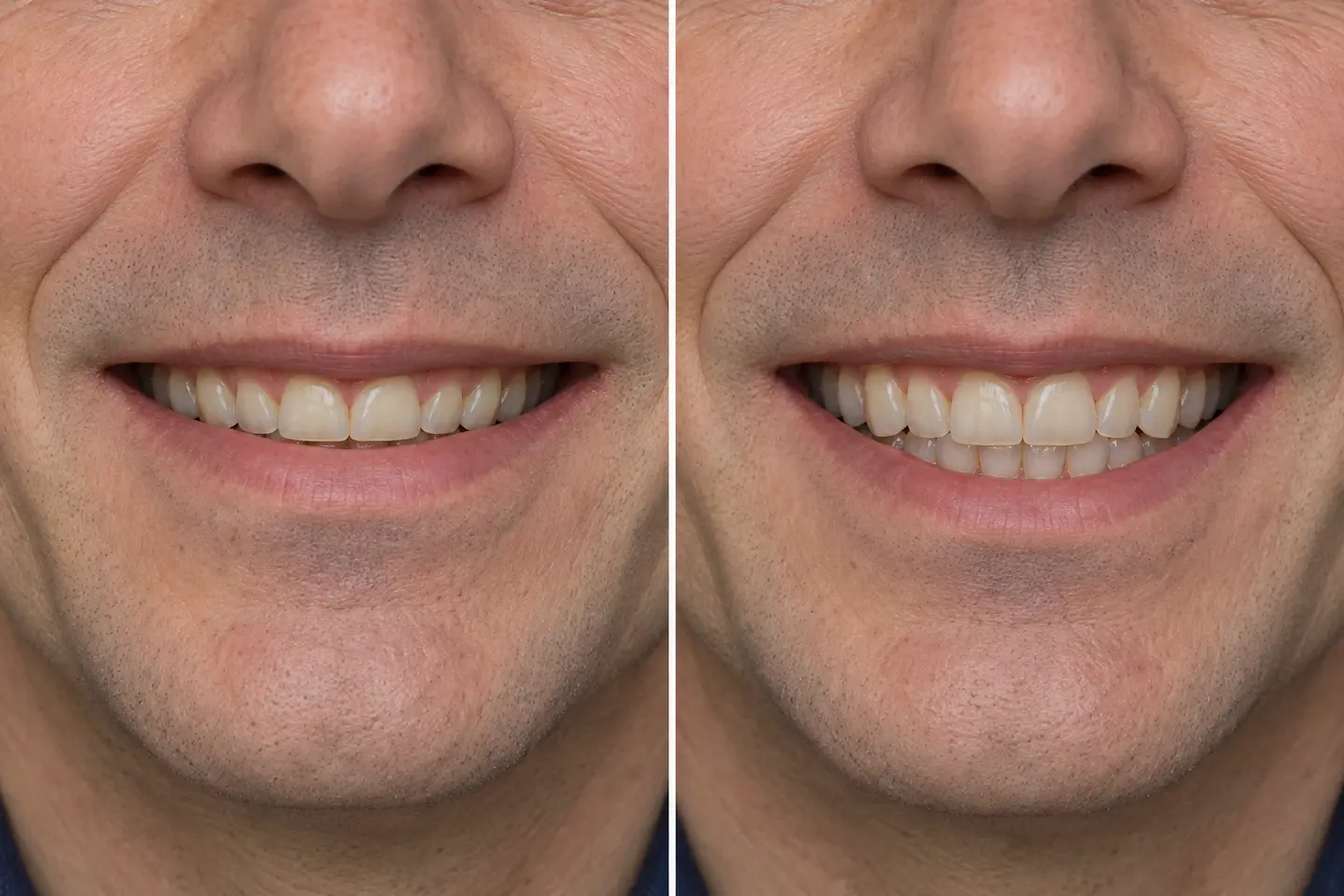 Exemplo ilustrativo de mordida profunda antes e depois do alinhamento ortodôntico